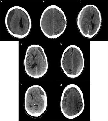Peripheral blood eosinophil and classification of residual hematoma help predict the recurrence of chronic subdural hematoma after initial surgery